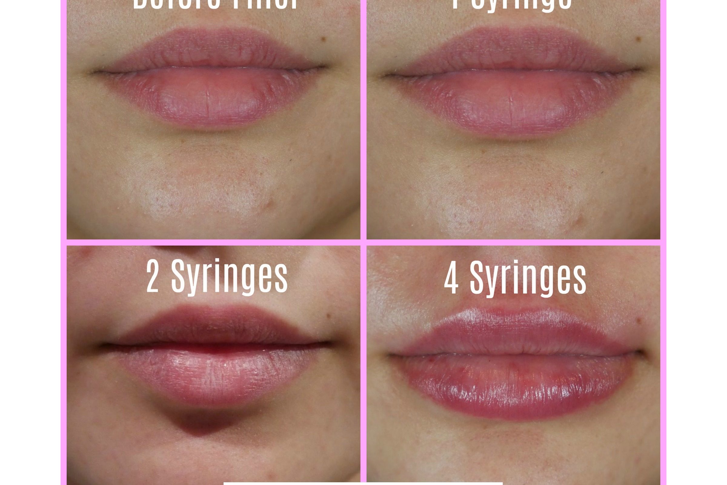 one-two-or-four-syringes-filler-lip-results-charmed-medispa