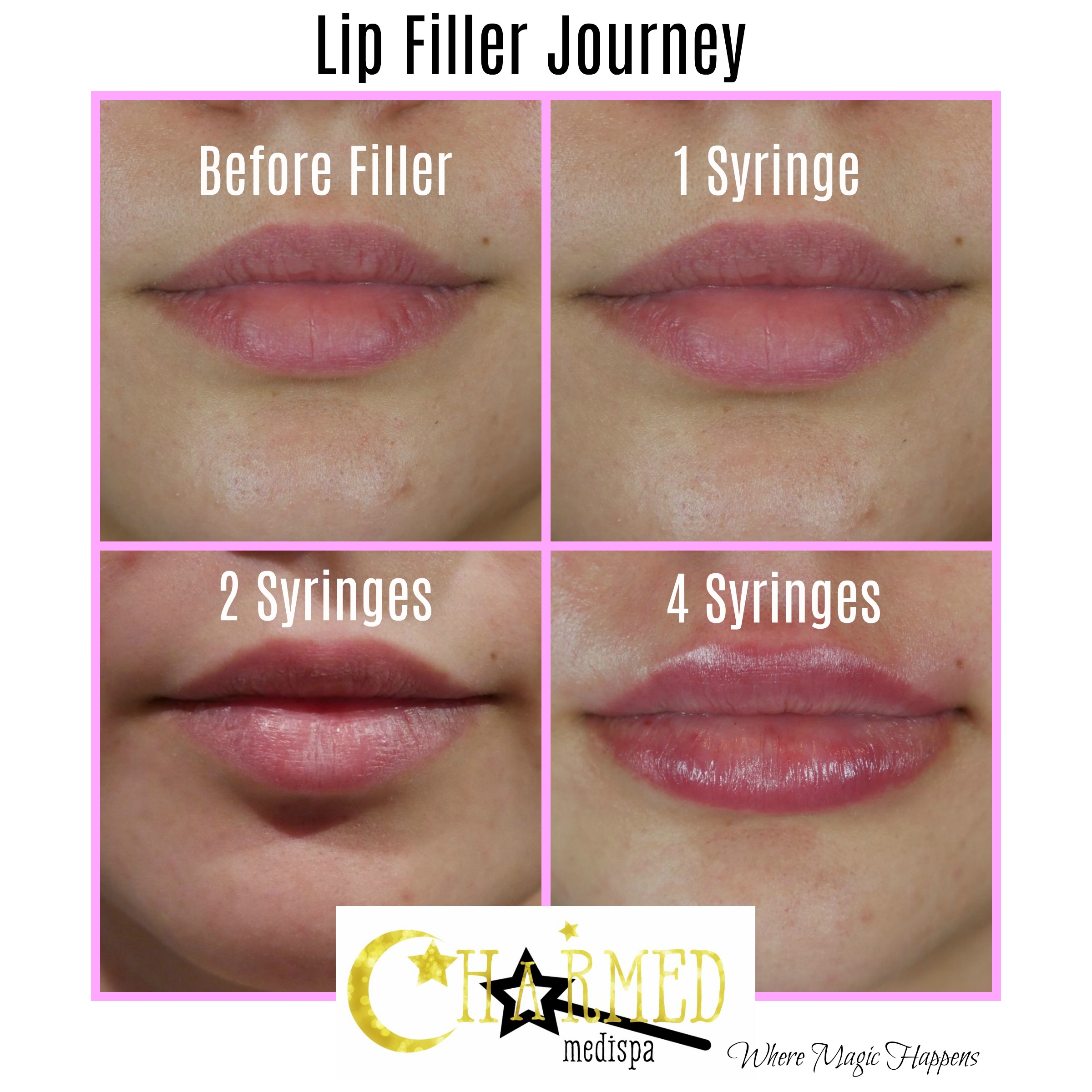 filler lip syringes results fillers four lips juvederm restylane dermal journey jun perfect