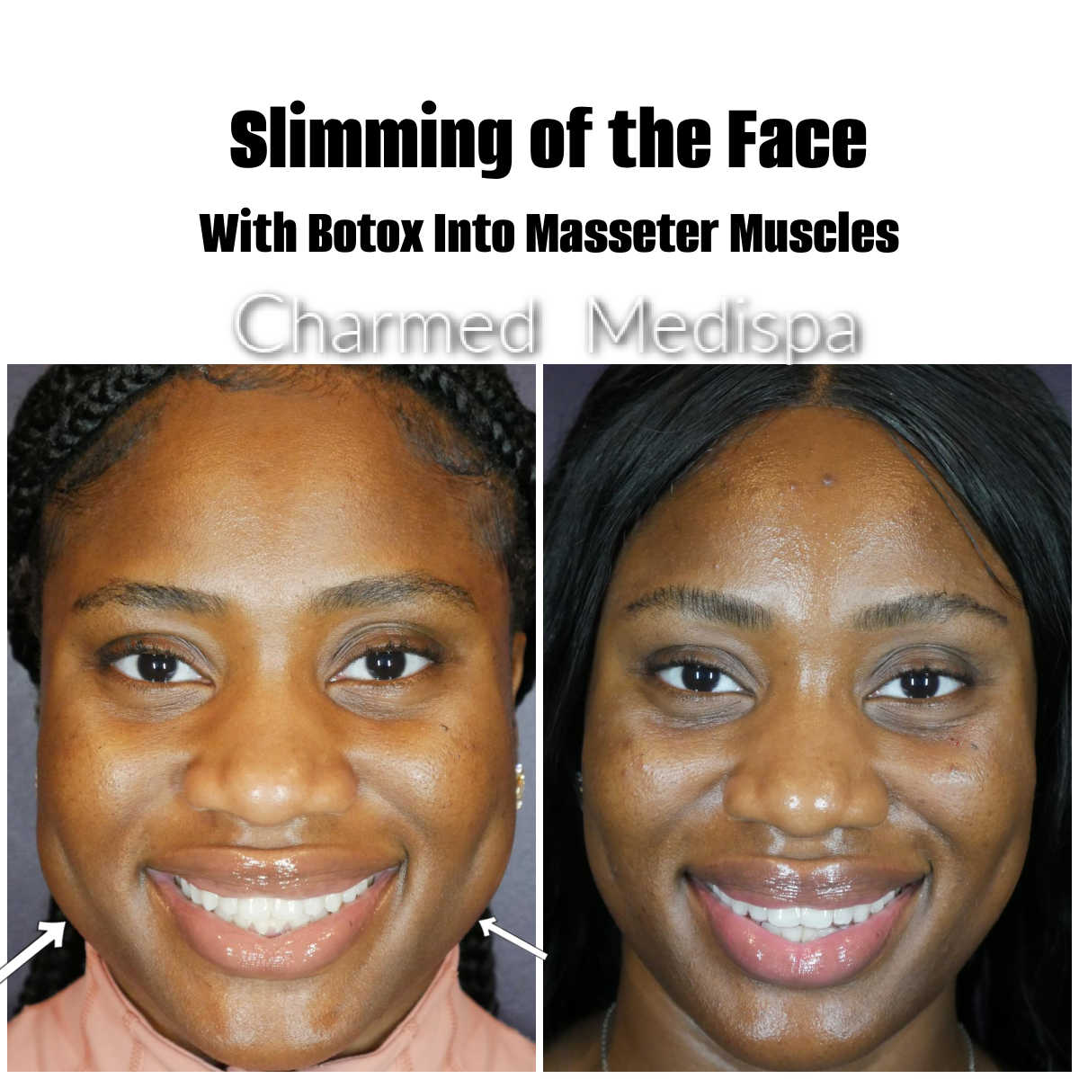 https://www.charmedmedispa.com/wp-content/uploads/Charmed-Medispa-Botox-Masseters-Slimming-Face-1.jpg