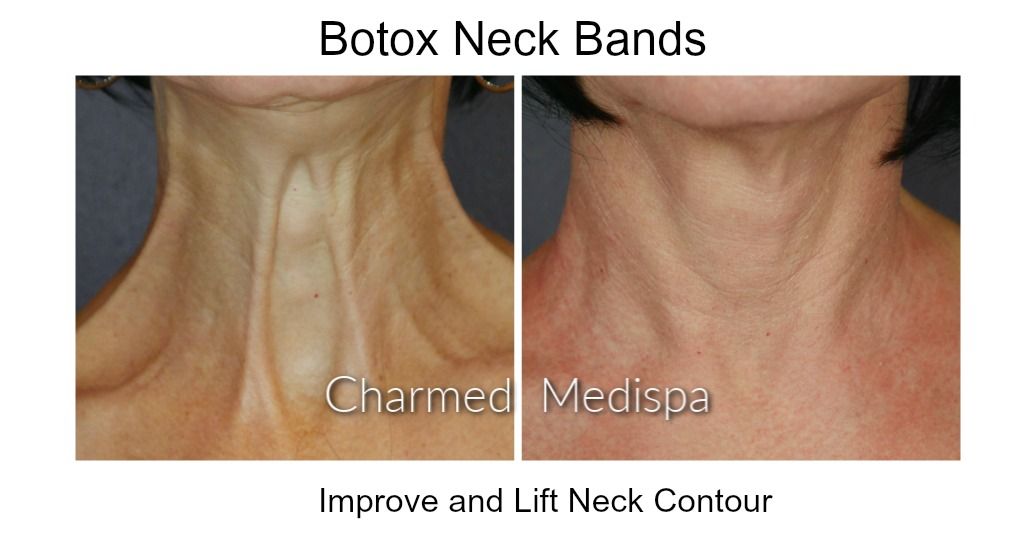 Microbotox Chest And Neck For Wrinkles – Charmed Medispa