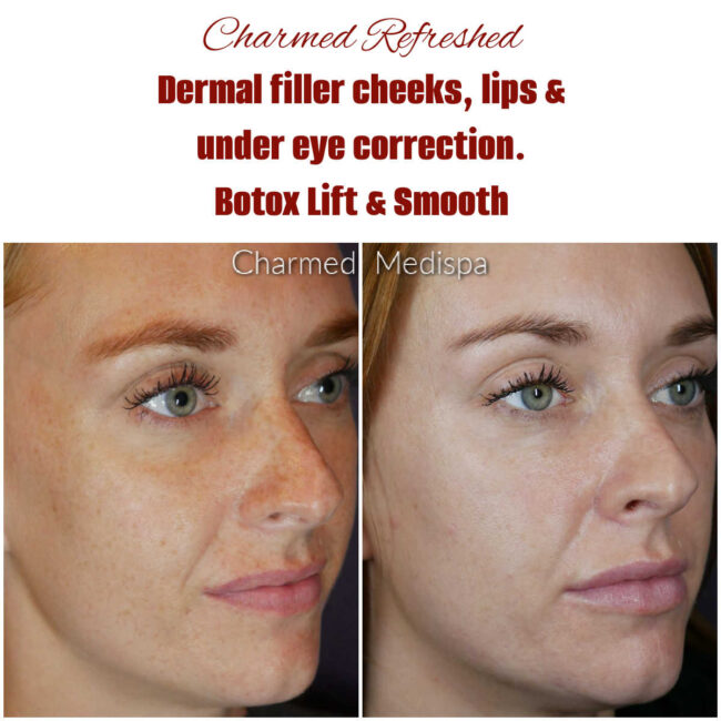 Dermal Fillers – Charmed Medispa