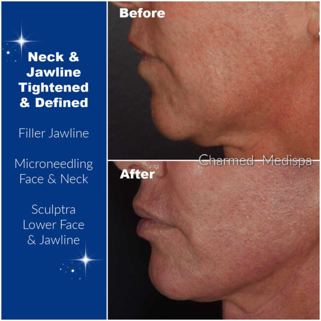Botox Masseter Muscles To Slim Face And Improve Teeth Grinding – Charmed  Medispa