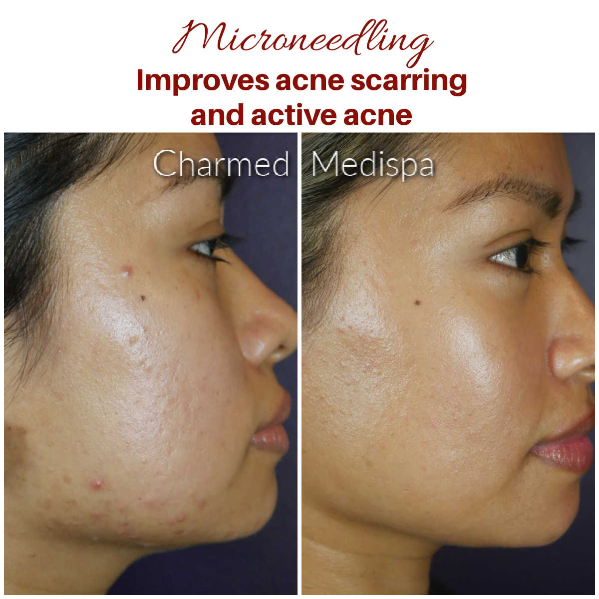 Charmed Medispa Microneedling Acne Scarring Results 1 