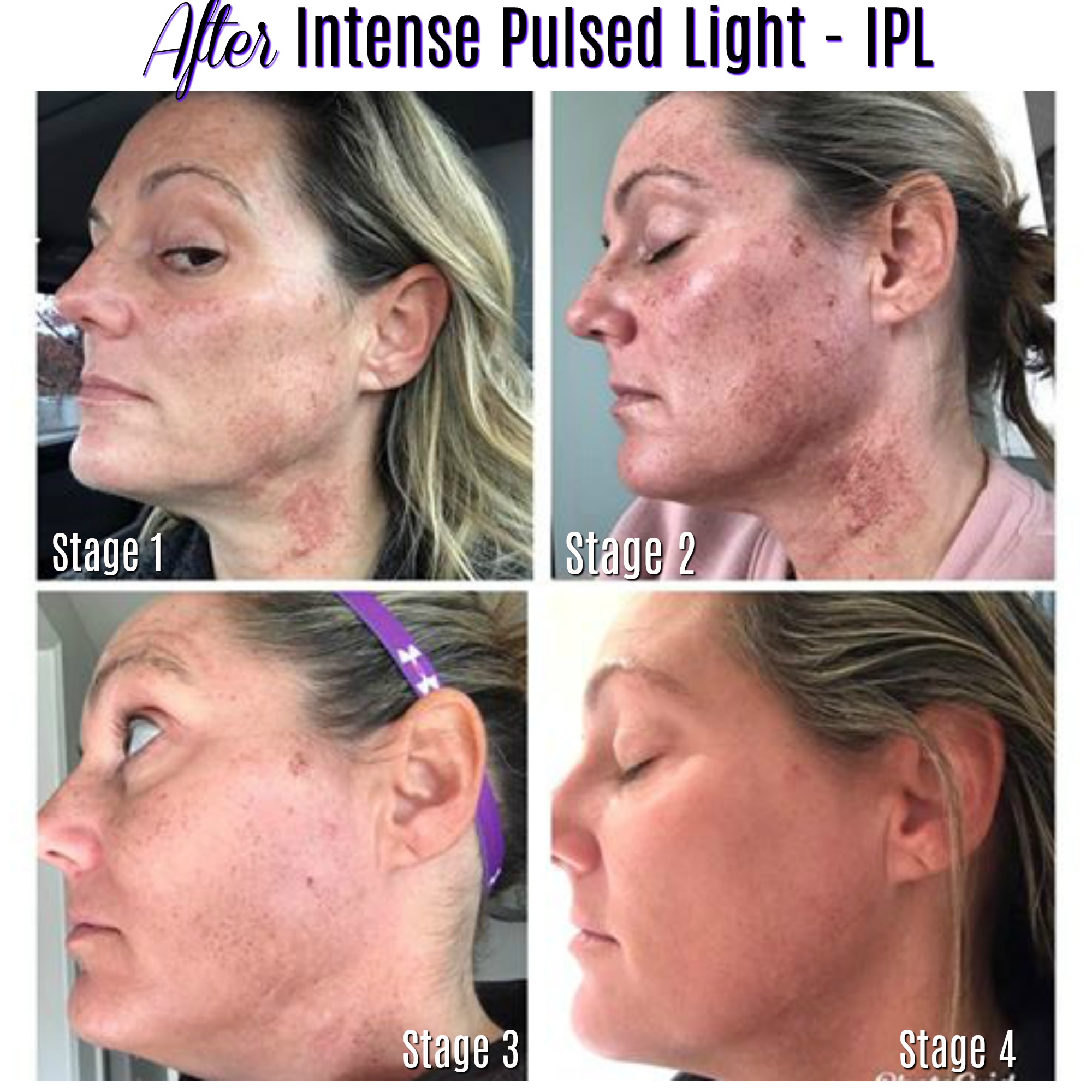 IPL for Brown and Red Spots Bend OR, IPL Treatment Redmond