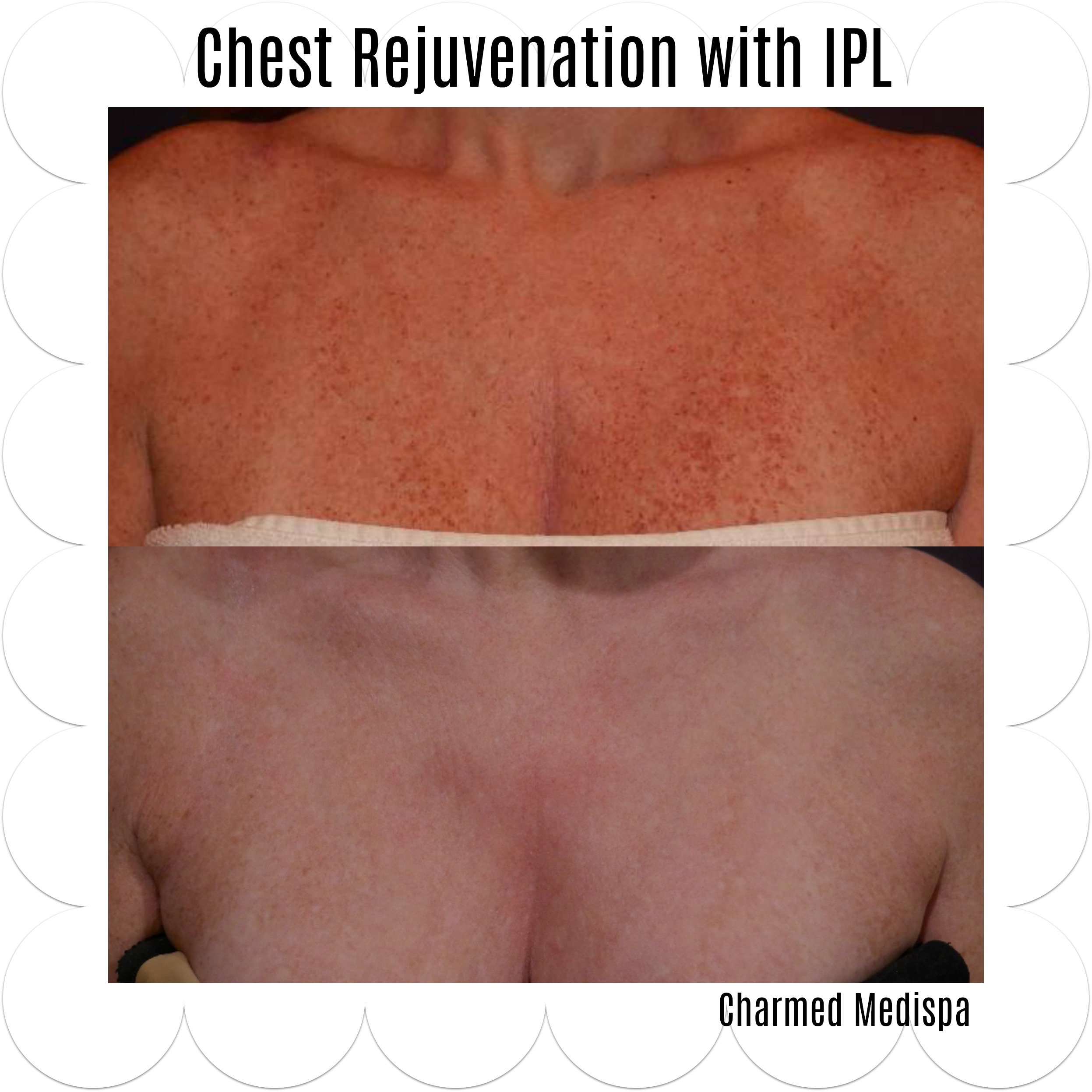 Rejuvenation of the Chest and Décolletage