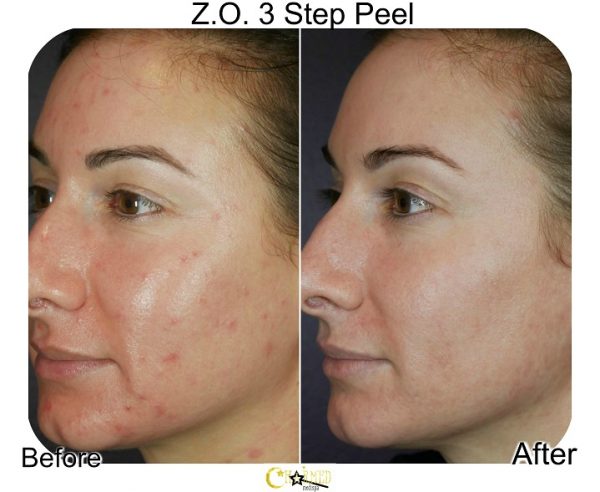 Chemical Peel Season – Charmed Medispa